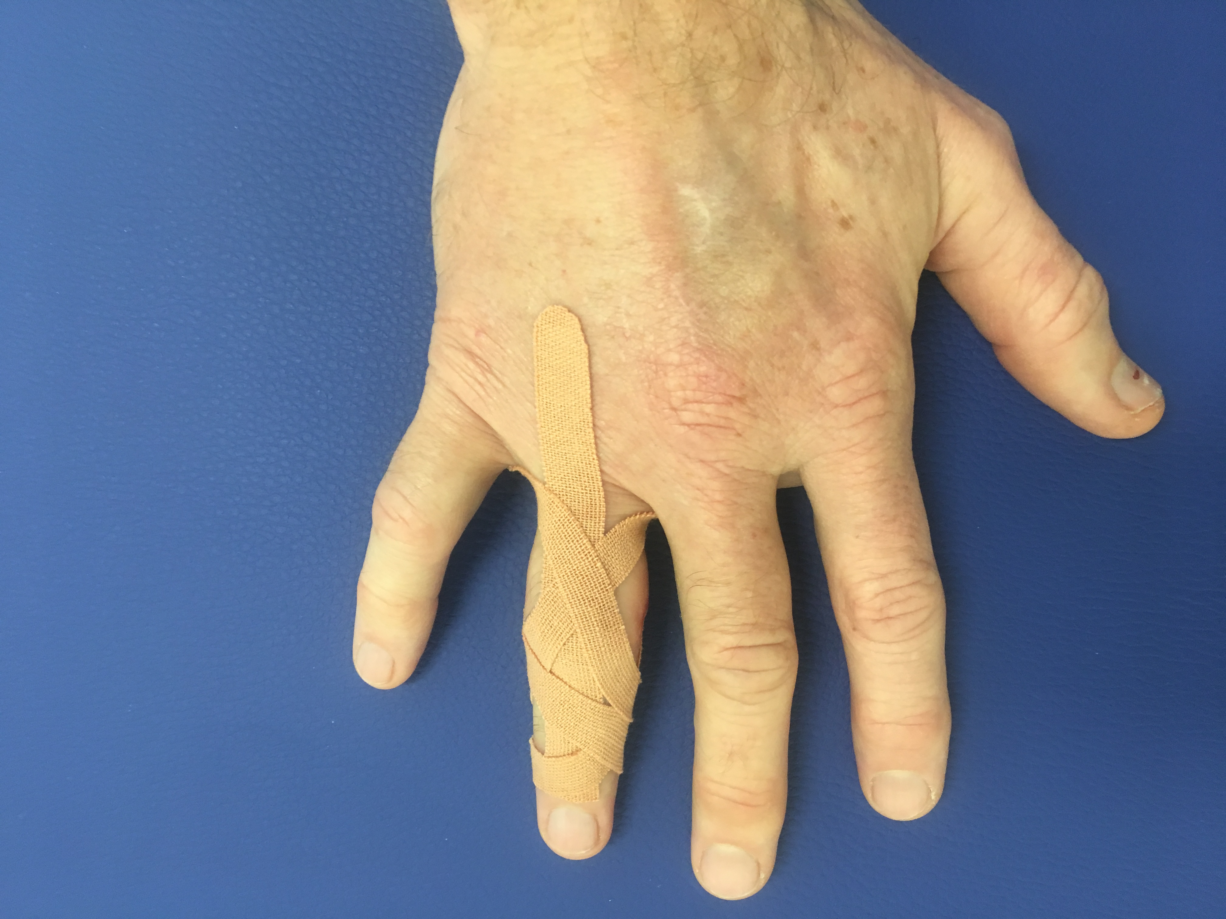 Čo s opuchnutým prstom?