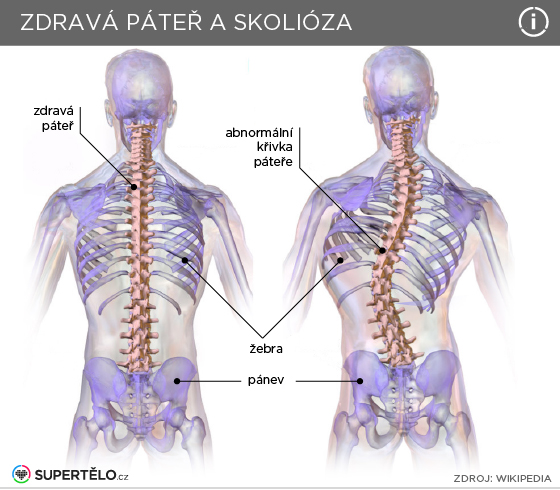 Hrbol Ek Na Lopatke Pr Pad Z Praxe Fyzioactive