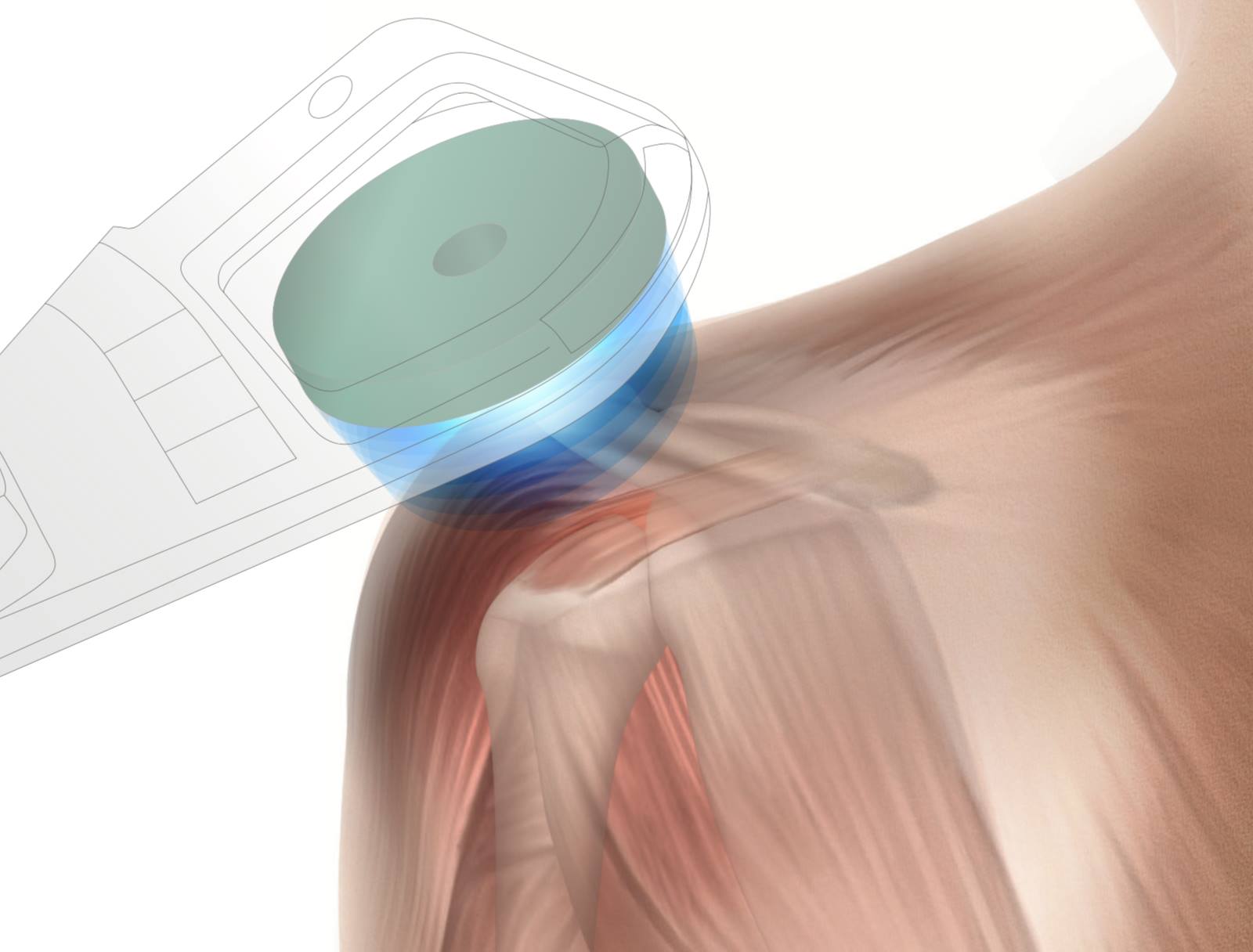 Vysokofrekvenčná magnetoterapia