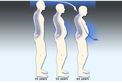 Osteoporóza a liečba